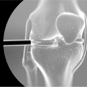 HYALGAN® Injection for Knee Pain (Fluoroscopic Guided) - Spine ...